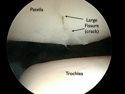 patella knee cartilage chondroplasty cap patellar chondromalacia treatment damage individual smoothed underwent using dislocation conditions